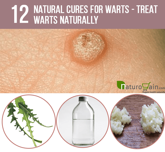 12 Natural Cures for Warts Treat Warts Naturally