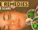 Best Home Remedies for Acne Scars