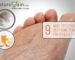 Home Remedies for Athlete's Foot