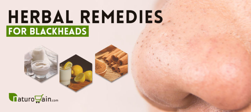 View of 9 Simple and Best Home Remedies for Blackheads that Work [Fast]