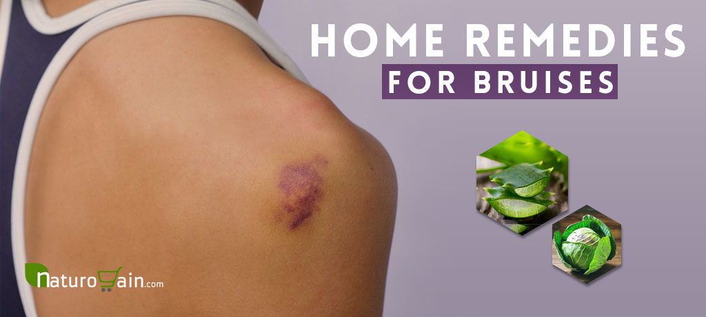 Home Remedies for Bruises