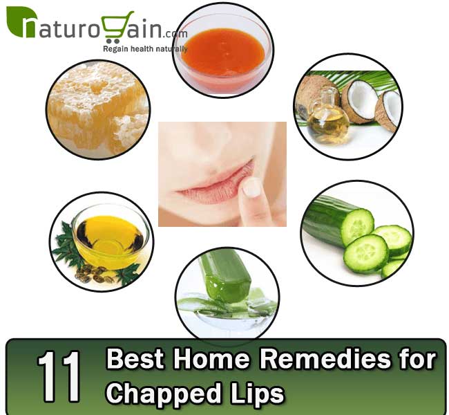 11 Best Home Remedies for Chapped Lips to Get Rid of Cracked Lips