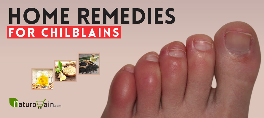 Home Remedies for Chilblains