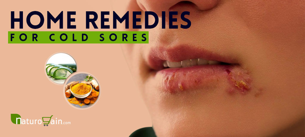 Home Remedies for Cold Sores