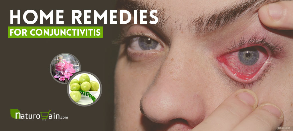 Best Home Remedies for Conjunctivitis