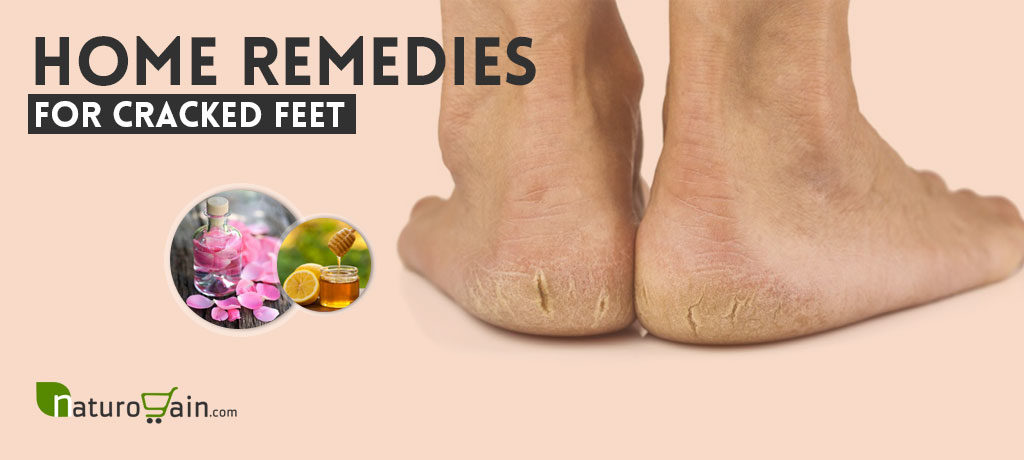 Home Remedies for Cracked Feet