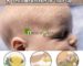 Home Remedies for Cradle Cap