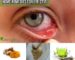 Home Remedies for Eye Stye