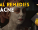 Herbal Remedies for Acne