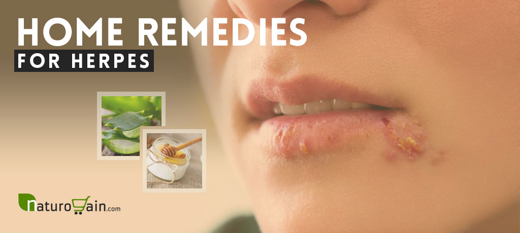 Home Remedies for Herpes