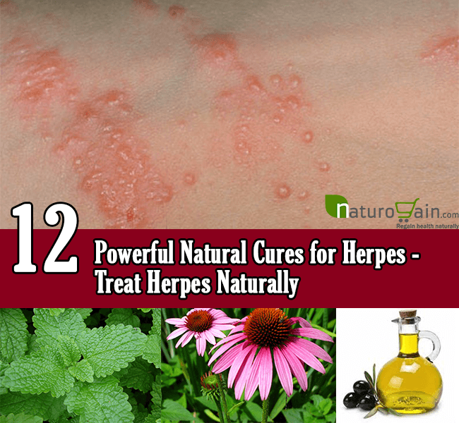 How do you treat herpes naturally? Natural remedies pocket guide