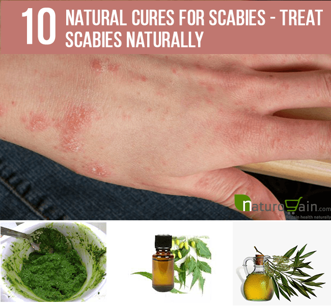 Scabies Natural Cure 102