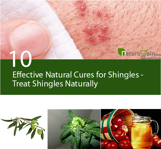 10 Effective Natural Cures for Shingles Treat Shingles