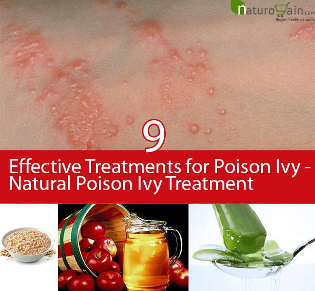 Poison Ivy Treatment Ncbi