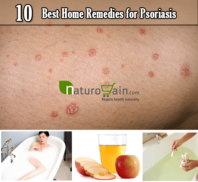 10 Simple and Best Home Remedies for Psoriasis