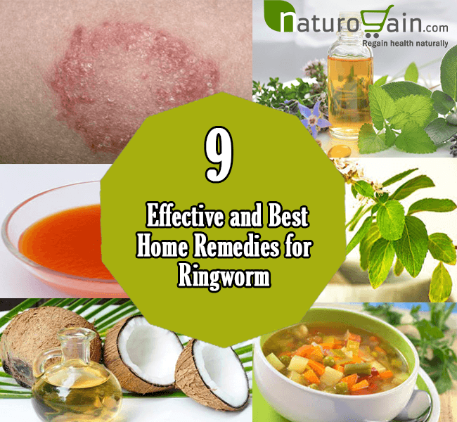 9 Best Home Remedies for Ringworm to Prevent Infection