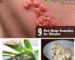 Home Remedies for Shingles