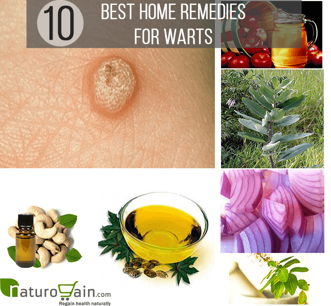 10 Effective And Best Home Remedies For Warts 10 Effective And Best Home Remedies For Warts
