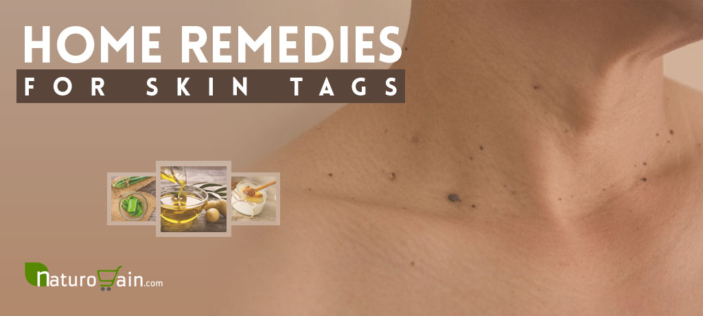 Home Remedies for Skin Tags