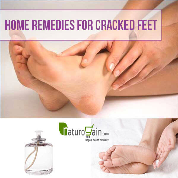6 Splendid Home Remedies For Cracked Feet And Sore Heels