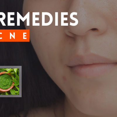 home remedies for acne scars on face