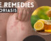 Natural Home Remedies for Psoriasis