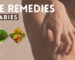 Best Home Remedies for Scabies