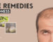 Best Home Remedies for Baldness