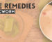 Home Remedies for Ringworm