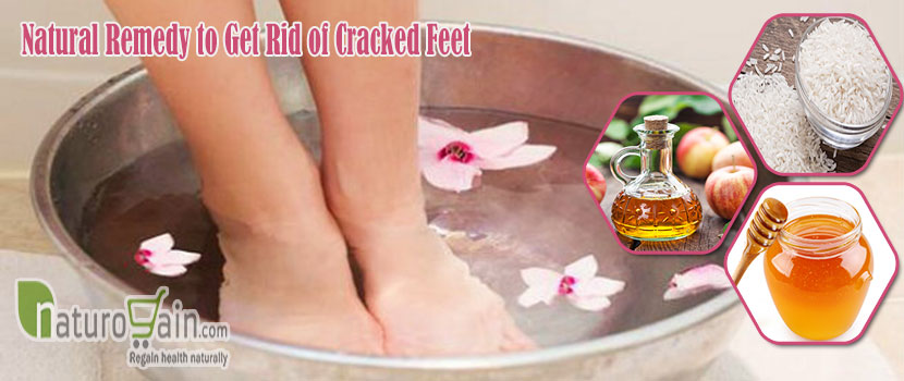 Natural Remedy to Get Rid of Cracked Feet