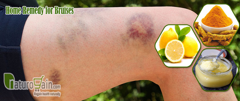 10 Best Home Remedies For Bruises To Relieve Pain And Swelling