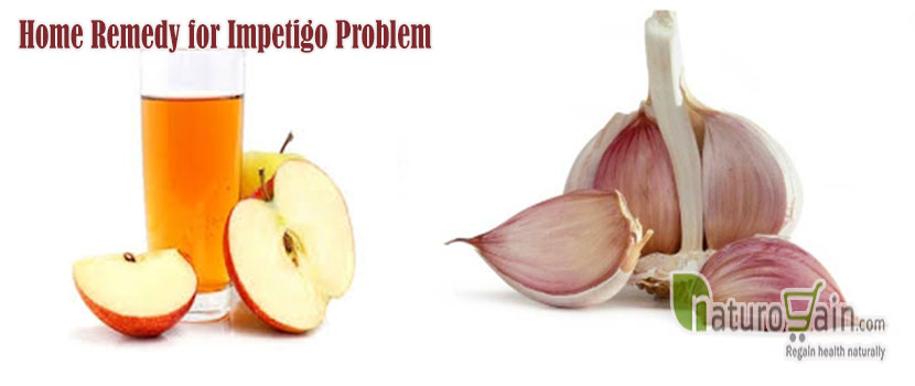 Home Remedy for Impetigo Problem