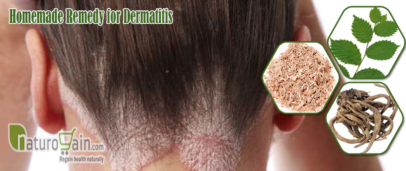 Homemade Remedy for Dermatitis