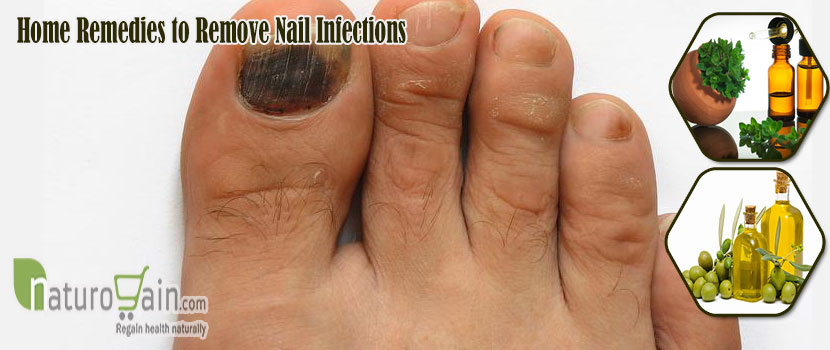 Remedies to Remove Nail Infections