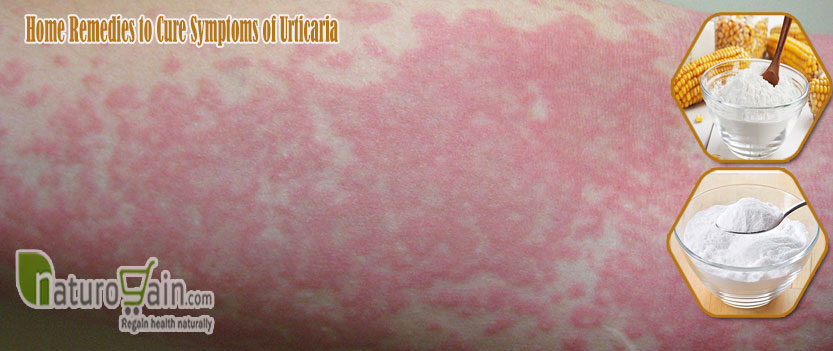 Home Remedies to Cure Symptoms of Urticaria