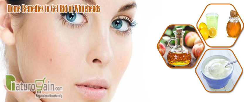 Home Remedies to Get Rid of Whiteheads