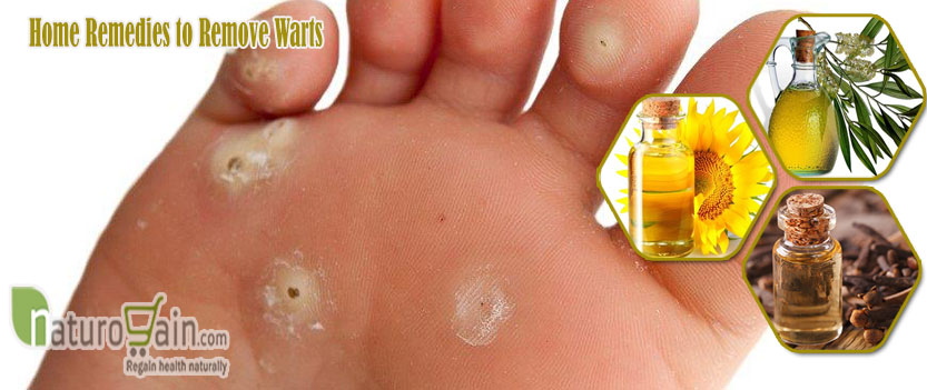 Home Remedies to Remove Warts