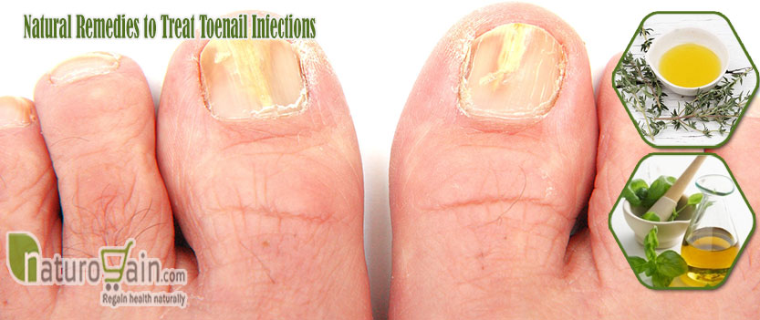 Natural Remedies to Treat Toenail Infections