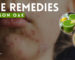 Home Remedies for Poison Oak