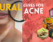 Natural Acne Cures