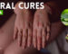 Natural Cures for Eczema