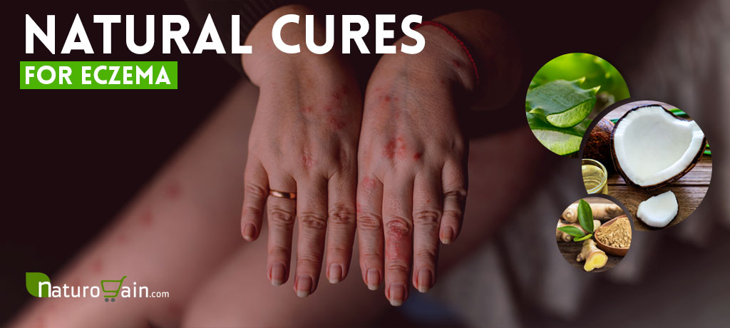 Natural Cures for Eczema