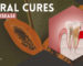 Natural Cures for Gum Disease