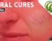 Natural Cures for Rosacea