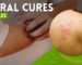 Natural Cures for Shingles