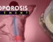 Natural Osteoporosis Treatment