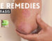 Best Home Remedies for Psoriasis