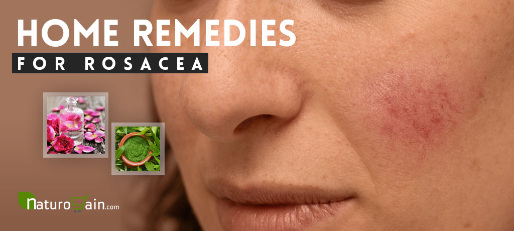 Best Home Remedies for Rosacea