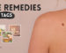 Best Home Remedies for Skin Tags