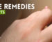 Best Home Remedies for Warts